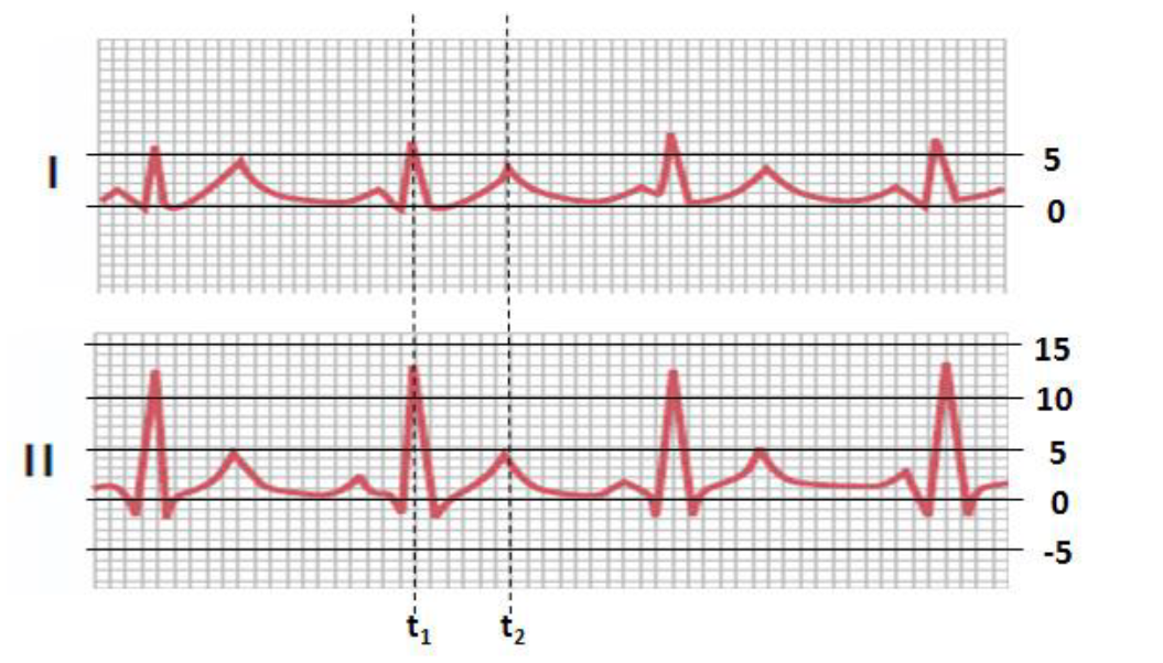 Question: Draw the cardiac vectors for the two leads In I and IIECG recording below: