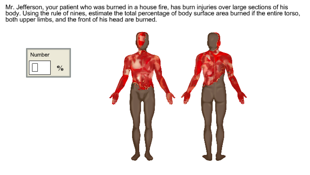 Solved Mr Jefferson Your Patient Who Was Burned In A Ho solved mr jefferson your patient who was burned in a ho