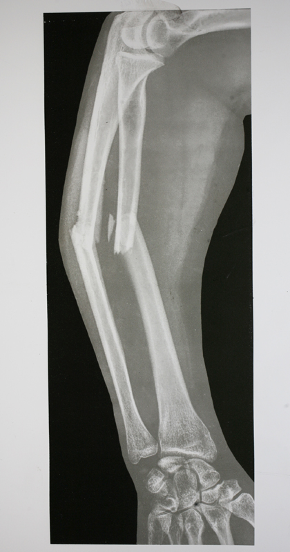 x rays of broken arm