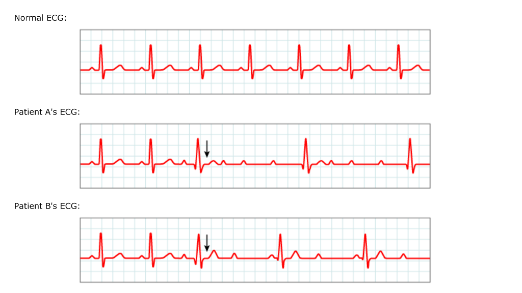 normal-vs-abnormal-ecg