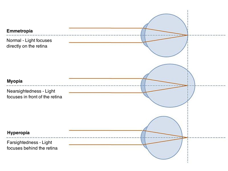 Solved Like a camera, the human eye focuses light to produce | Chegg.com