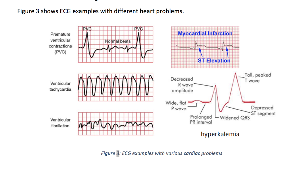 how-to-calculate-irregular-heart-rate-on-ecg-haiper