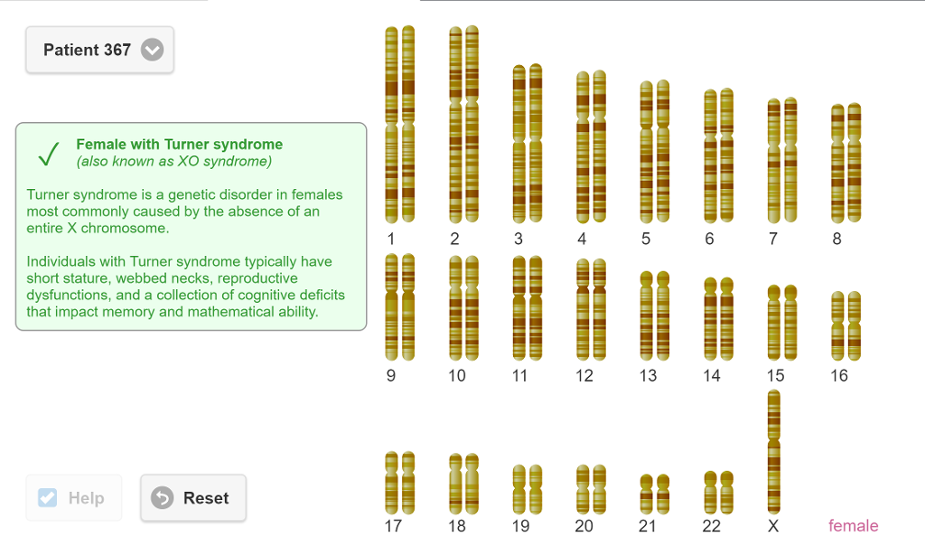 Solved Patient 367 Female with Turner syndrome (also known | Chegg.com