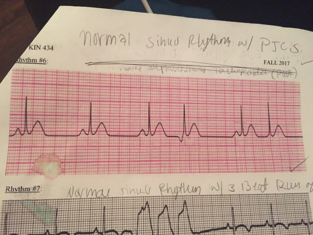 RHYTHM # NORMAL SINUS RHYTHM WITH PJC What is the | Chegg.com