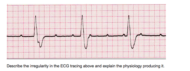 Solved Describe the irregularity in the ECG tracing above | Chegg.com