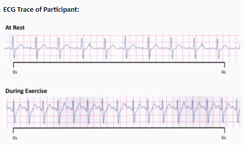 Solved A Participant Is Asked To Run On A Treadmill For 10 