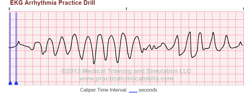 Solved EKG Arrhythmia Practice Drill Caliper Time Interval: | Chegg.com