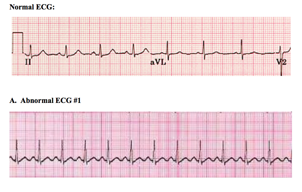 normal-vs-abnormal-ecg