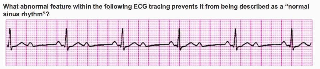 Solved A. not every QRS complex is preceded by a P-wave | Chegg.com