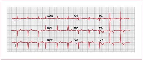 Solved V4 aVL V2 V5 aVF V3 V6 | Chegg.com