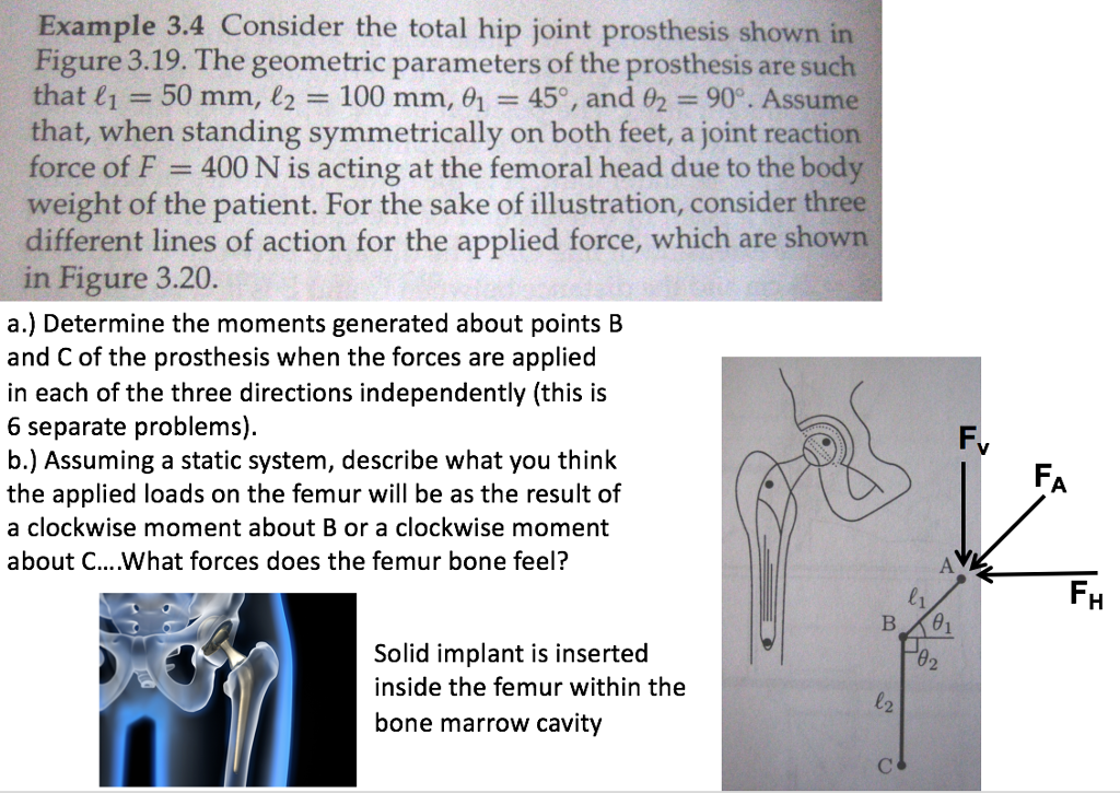 Solved Consider the total hip joint prosthesis shown in | Chegg.com