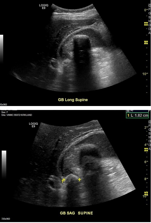 Solved Gall Bladder case study I am an Ultrasound student | Chegg.com