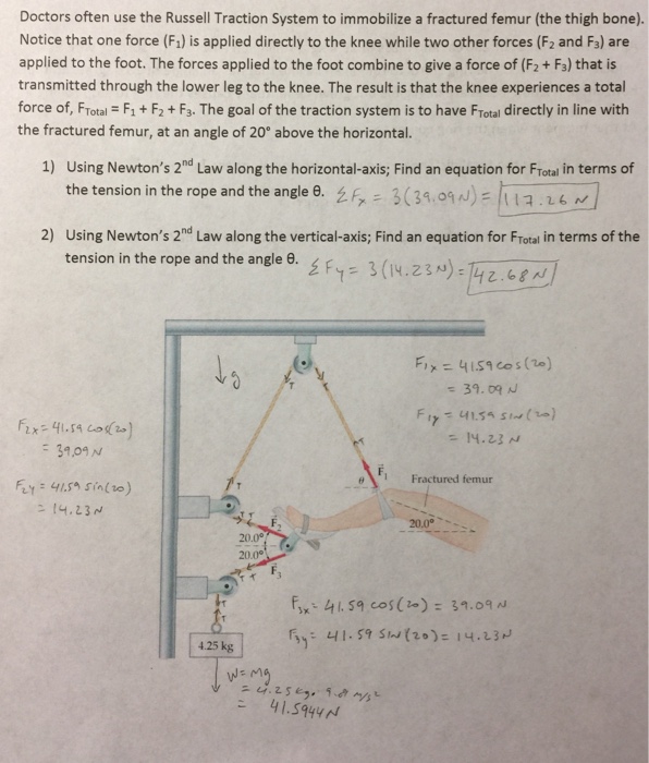 Solved Doctors often use the Russell Traction System to