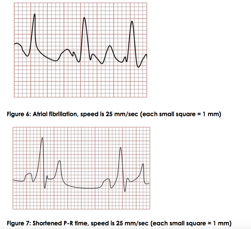 Solved EKG ANALYSIS HELP While I understand the concept of | Chegg.com