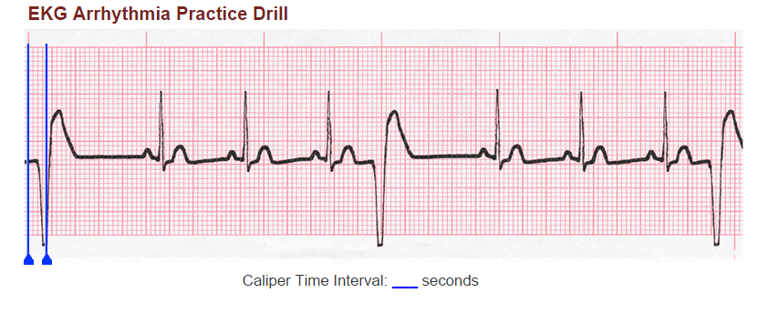 Solved EKG Arrhythmia Practice Drill Caliper Time Interval | Chegg.com