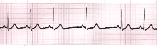 Solved Analyze 2 of these ECGs and determine what kind it is | Chegg.com