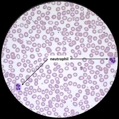 Solved hown below is an image of a peripheral blood film as | Chegg.com