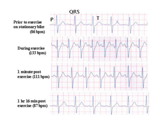 Solved 1. Based on the electrocardiograms of a person riding | Chegg.com